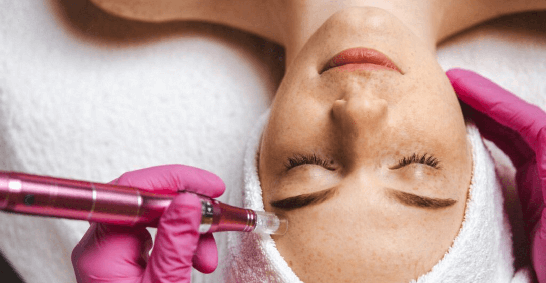 microneedling-harley-street