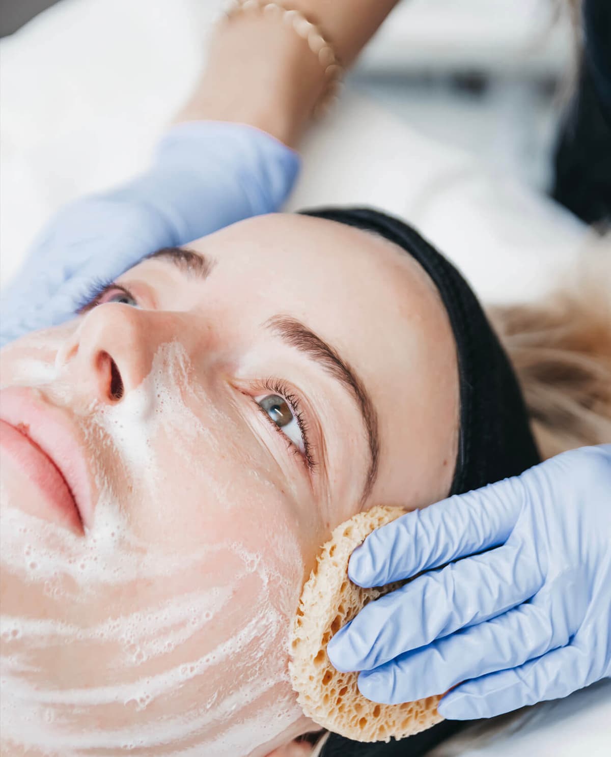 chemical-peel-treatment