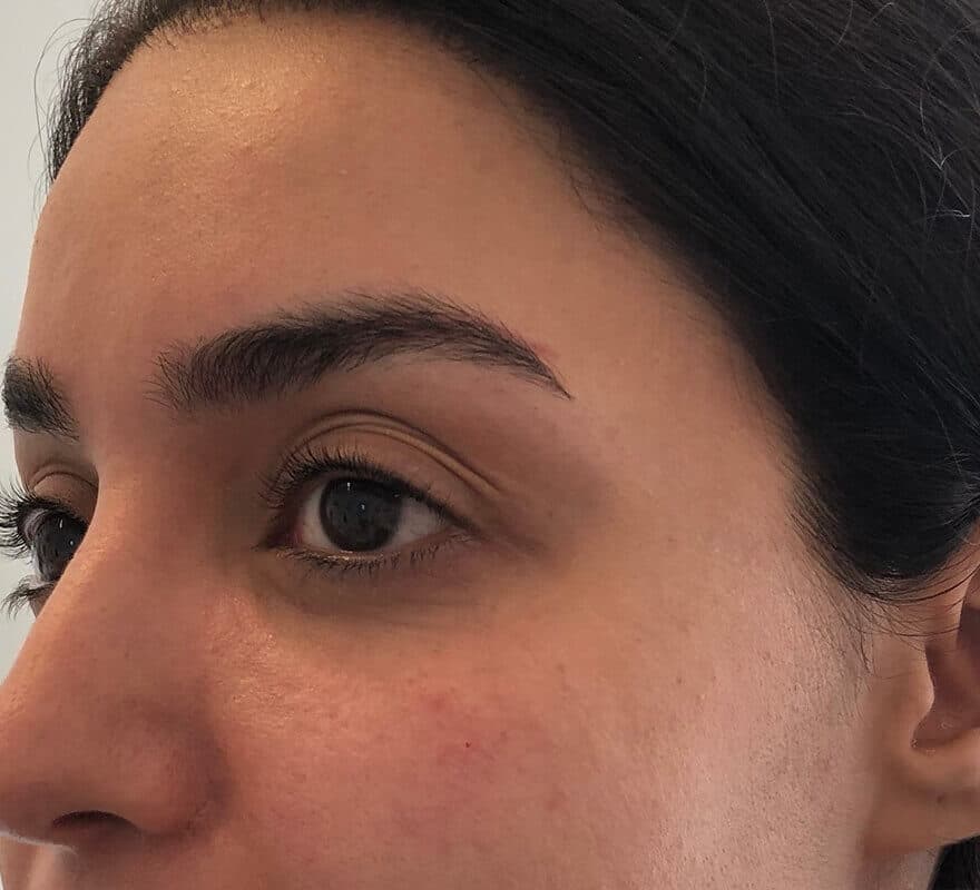 dark-circles-after-filler