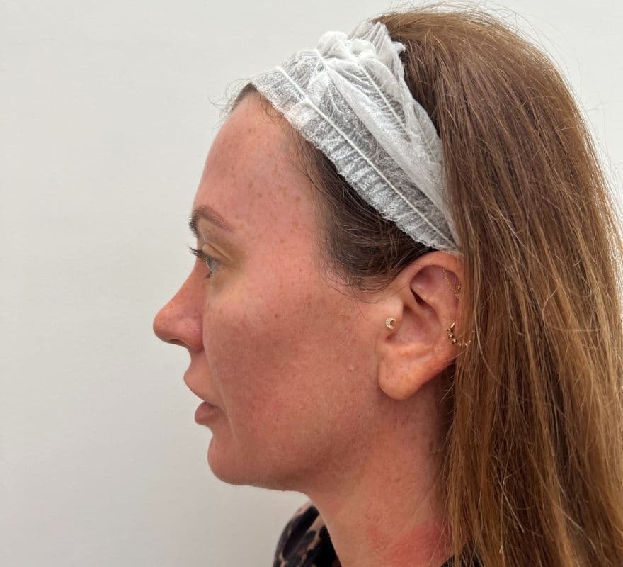 morpheus8-face-treatment