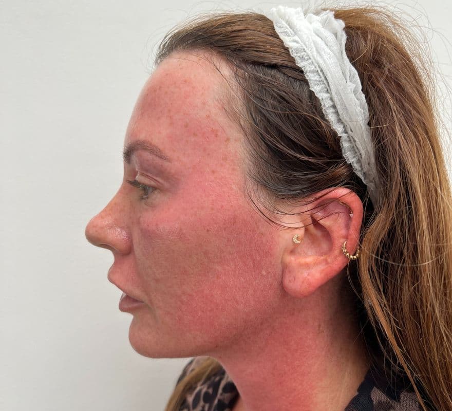 morpheus8-red-face-treatment