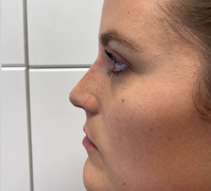 non-surgical-rhinoplasty-after