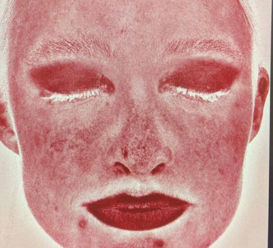 after-skincare-visia