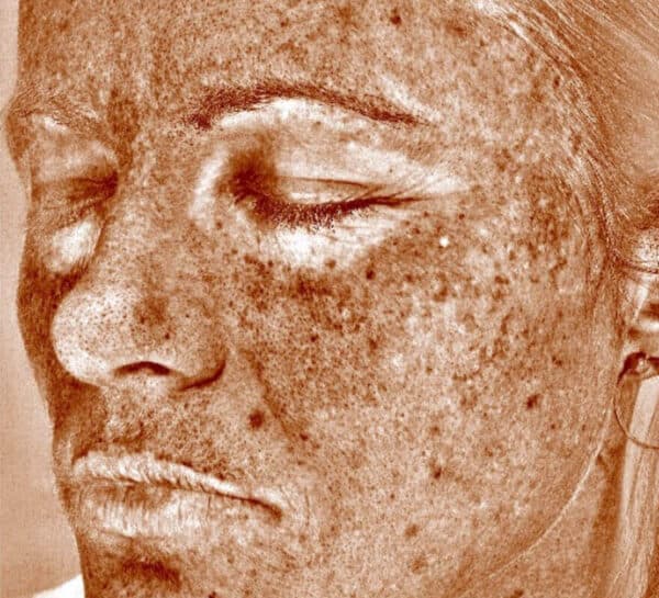 visia-after-face-image