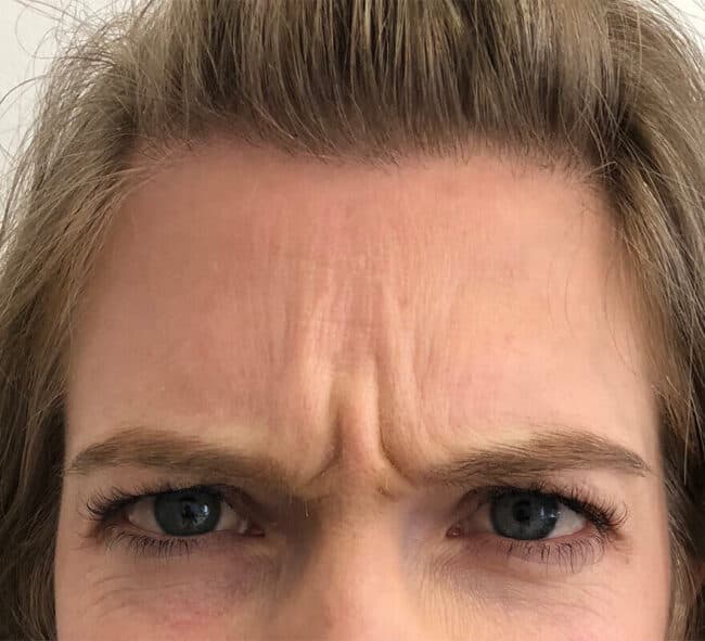 frown-face-brows-before-botox