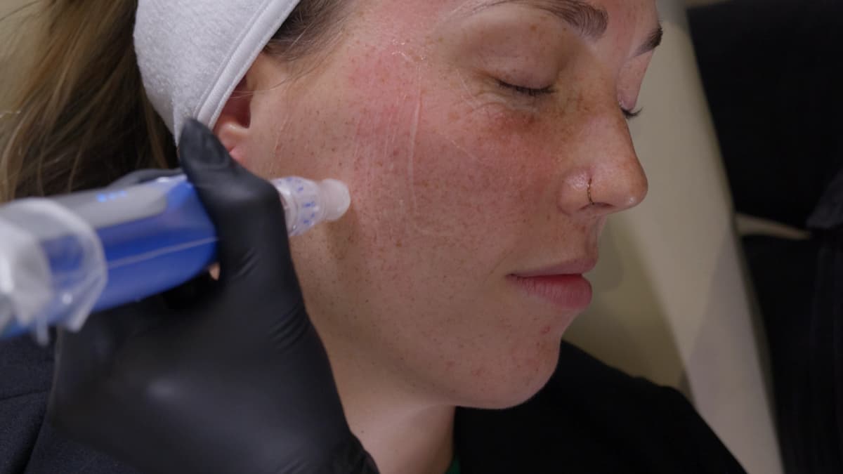 skinpen-treatment-harleyst