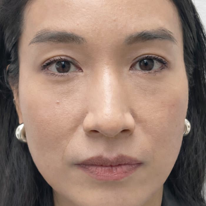 before-sofwave-treatment-harleyst