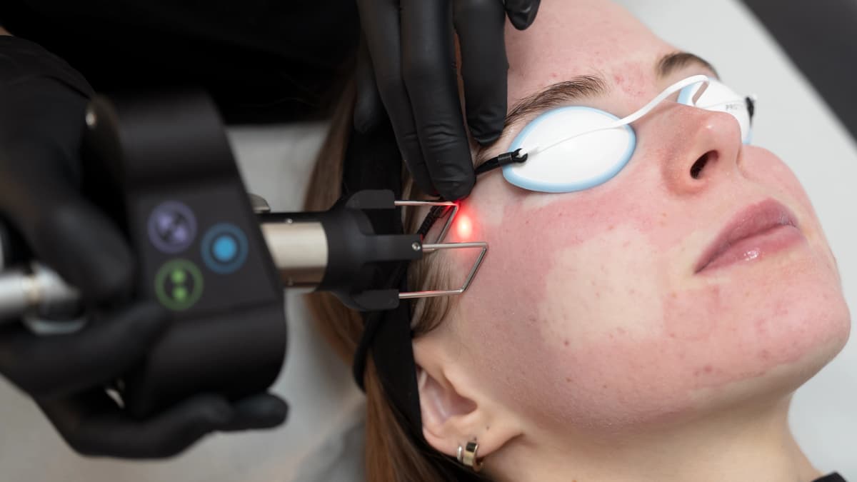 CoolPeel-laser-harleystreet