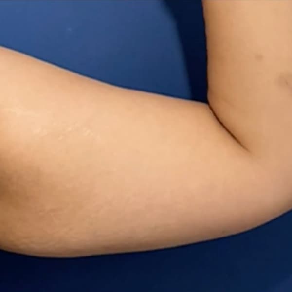 under-arm-before