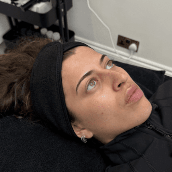 After-Hydrafacial