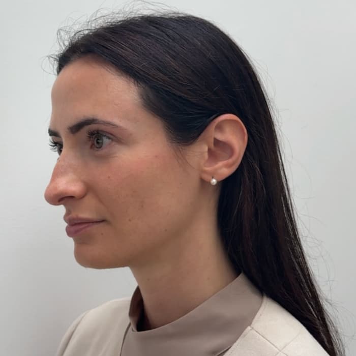 sofwave-patient-2-after