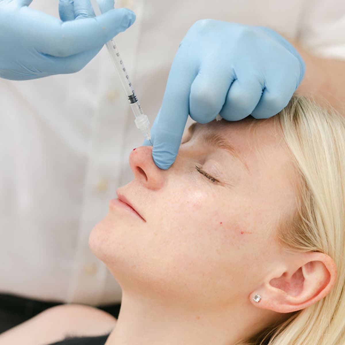 non-surgical-rhinoplasty