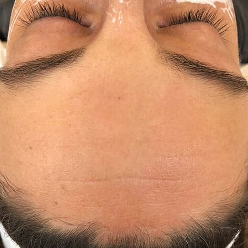 microneedling-forehead-close-up