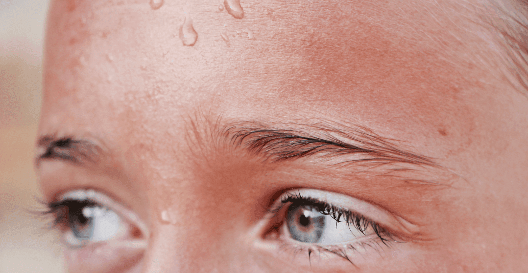 hyperhidrosis-sweating-forehead