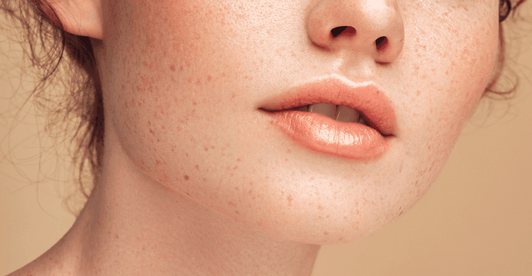 lip-fillers-face-closeup