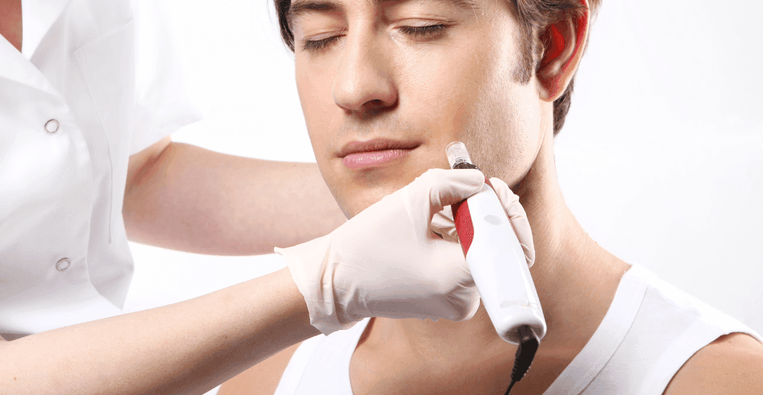 microneedling-patient-men