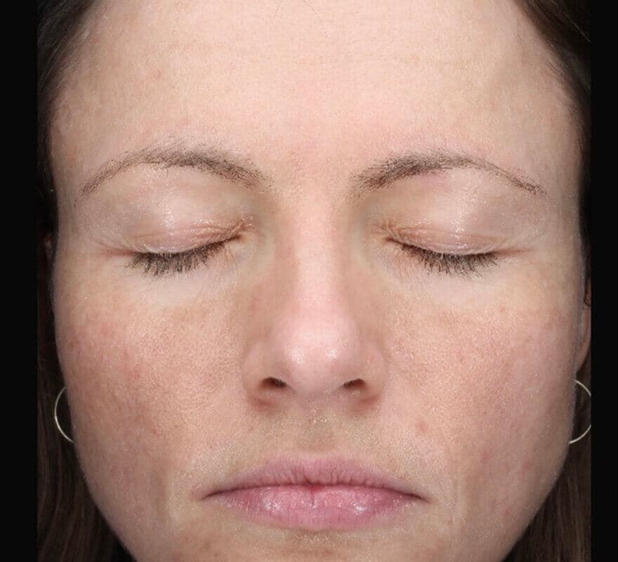 chemical-peel-after