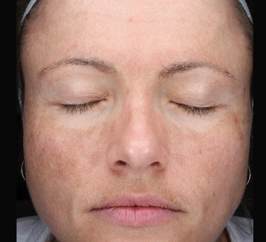 chemical-peel-before