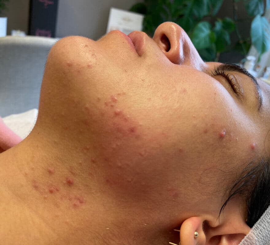 chemical-peel-before2