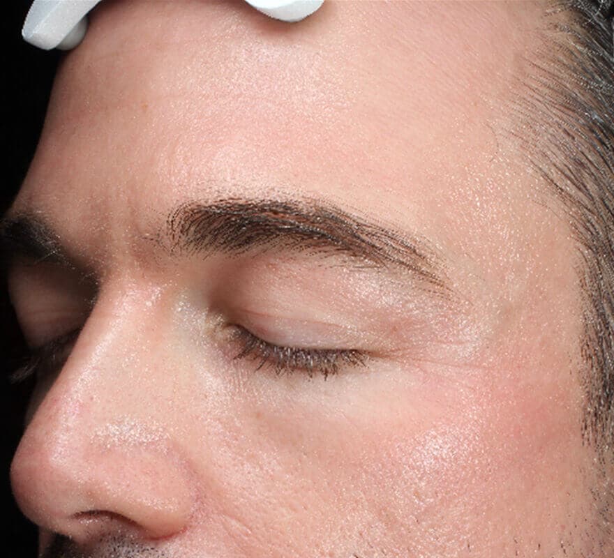 pigmentation-dermamelan-after