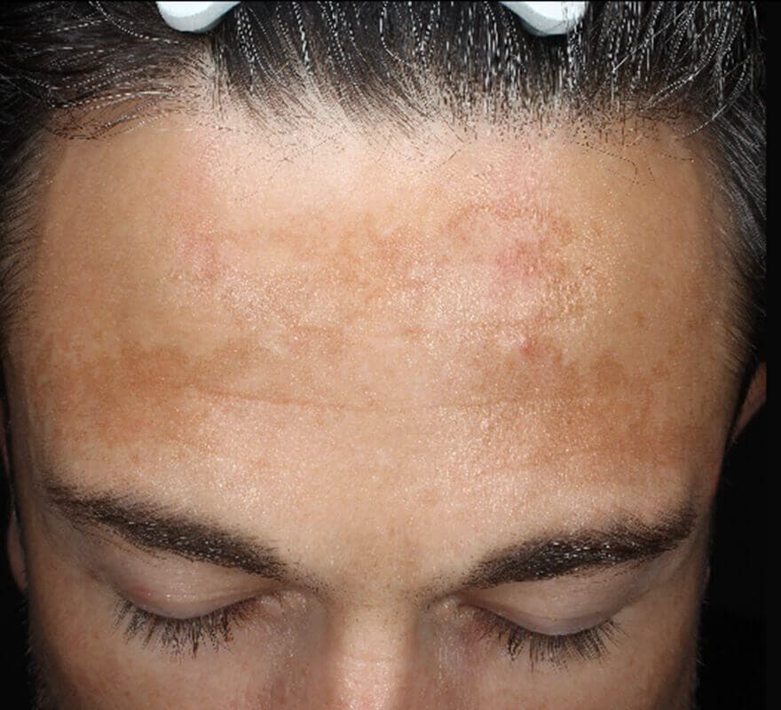 pigmentation-dermamelan-before