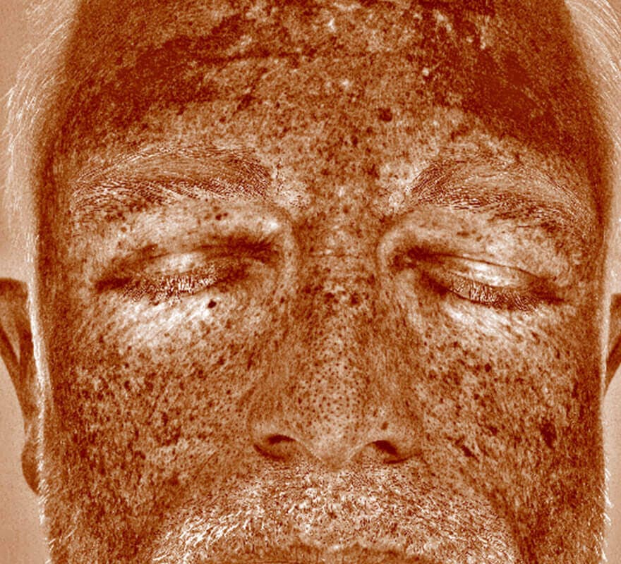 Dermamelan-before-treatment