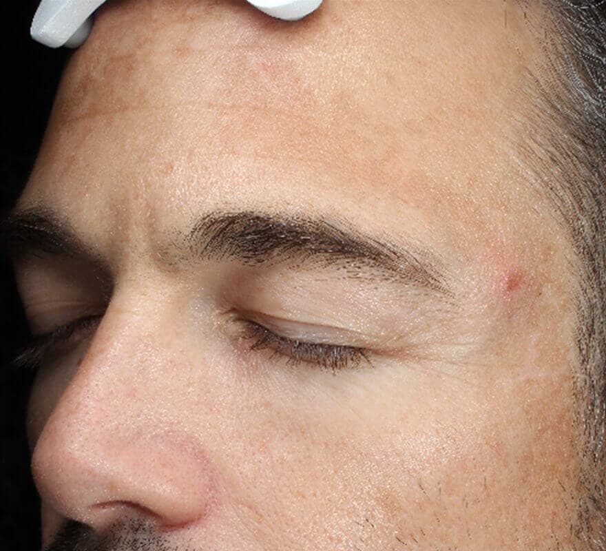 before-dermamelan-forehead-man