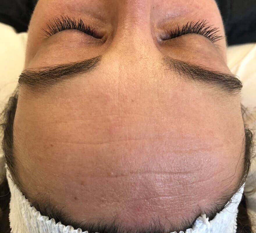 micro-needling-before