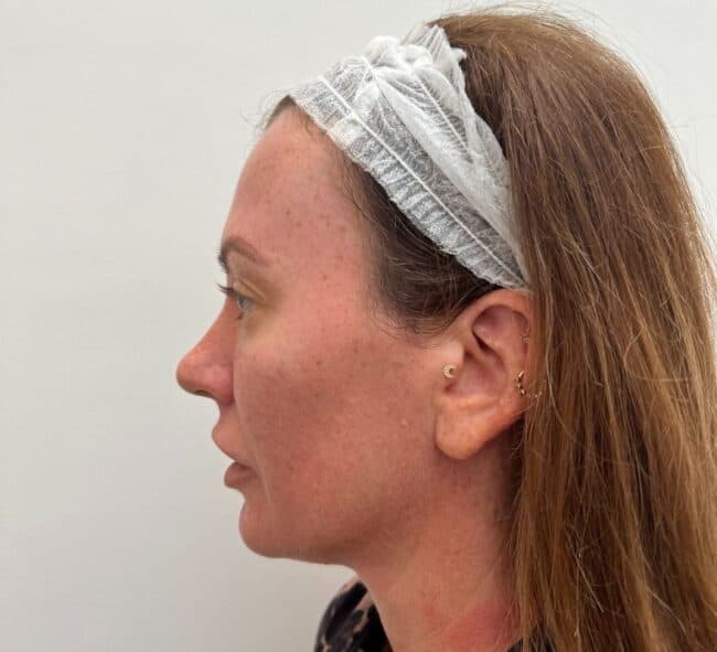 morpheus8-face-treatment