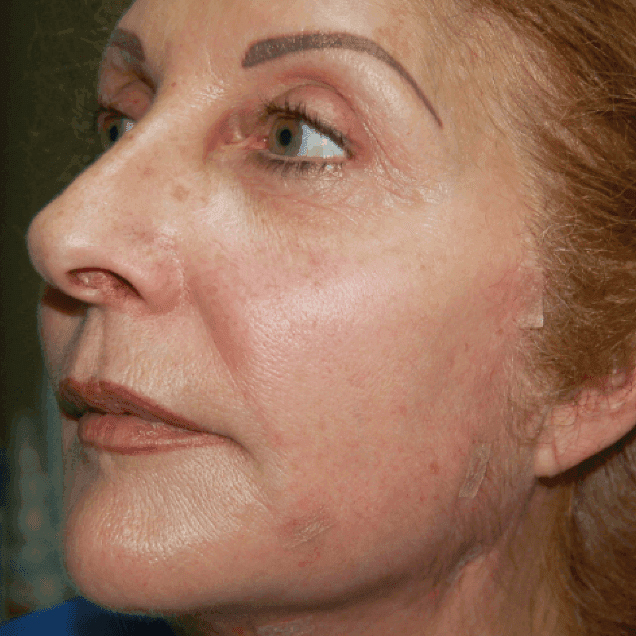 skin-treatment-cheek