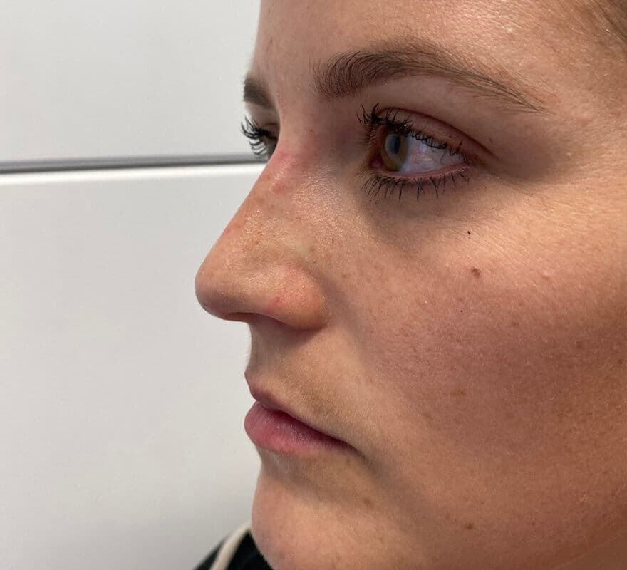 non-surgical-rhinoplasty
