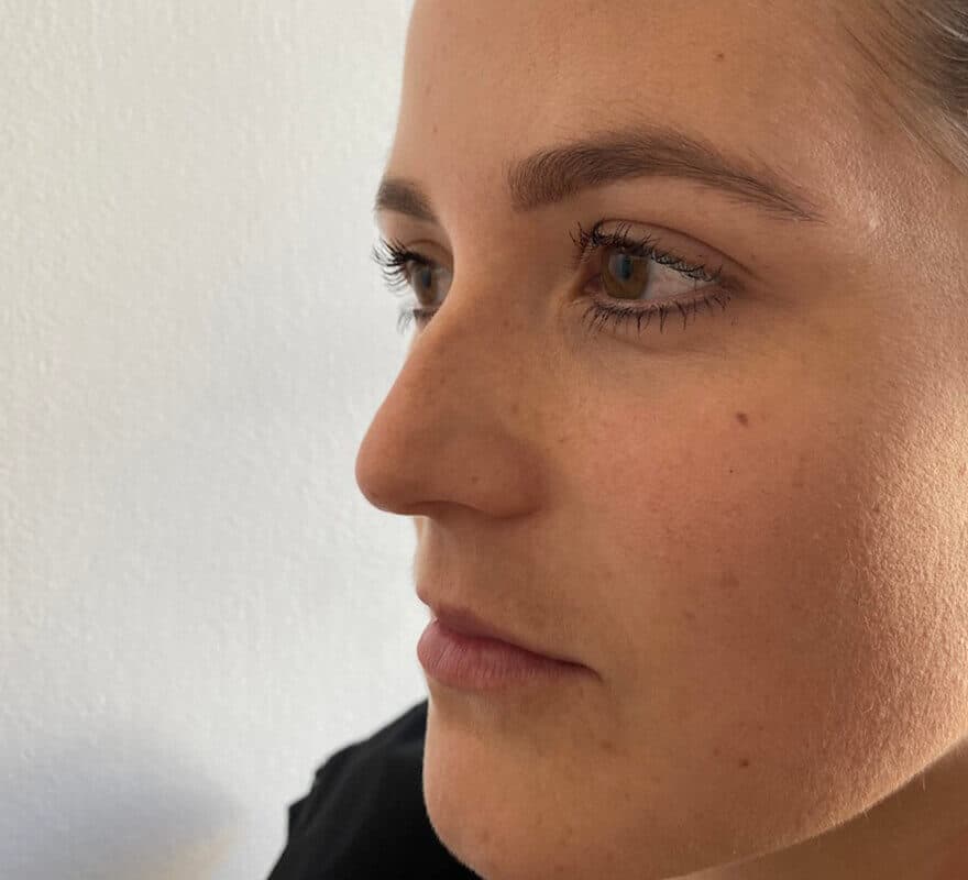 rhinoplasty-before-harleystreet
