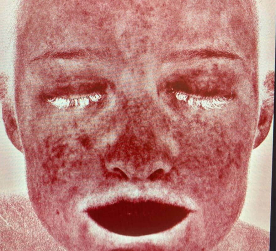 before-skincare-visia