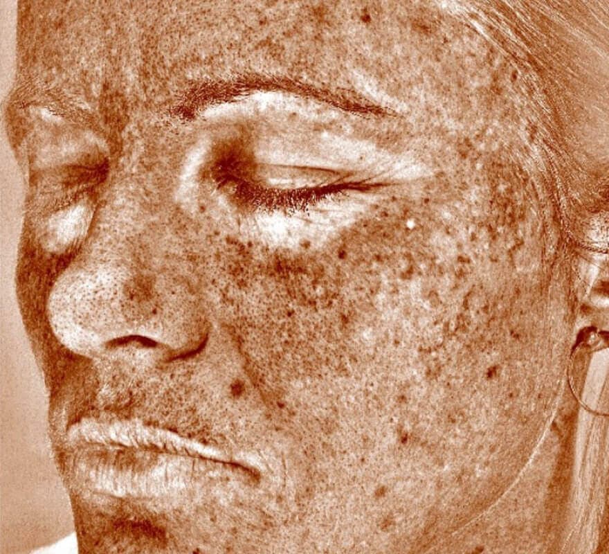 visia-after-face-image