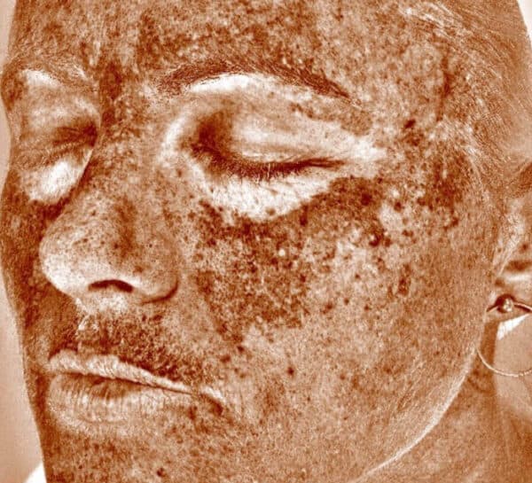 visia-before-face-image