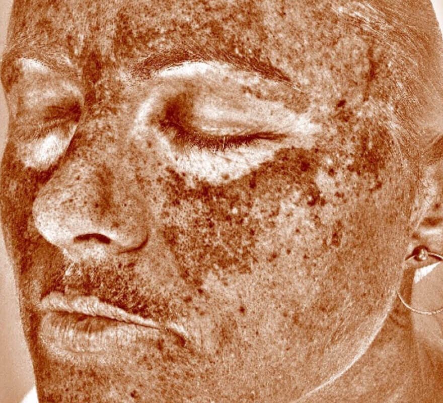 visia-before-face-image