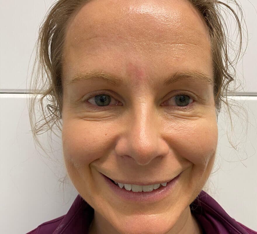 wrinkles-after-botox