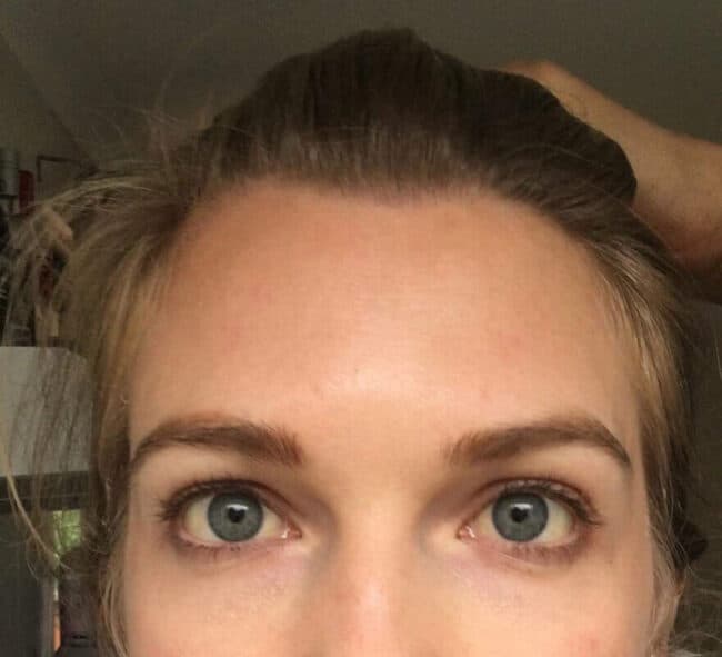 forehead-after-botox