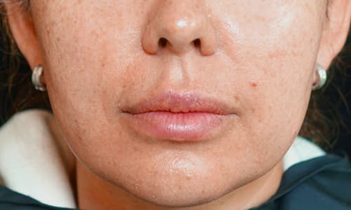 Julaine-patient-before-4