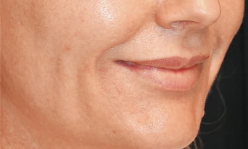 Julaine-result-before