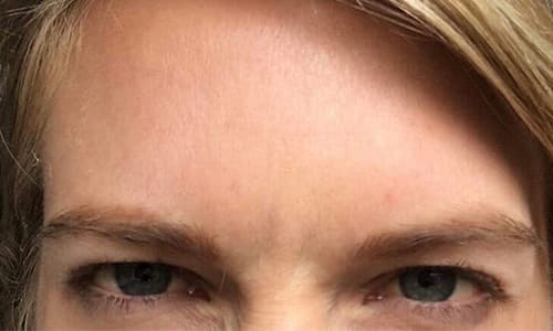 after-botox-harleystreet