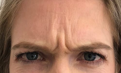 Before-botox-harleystreet