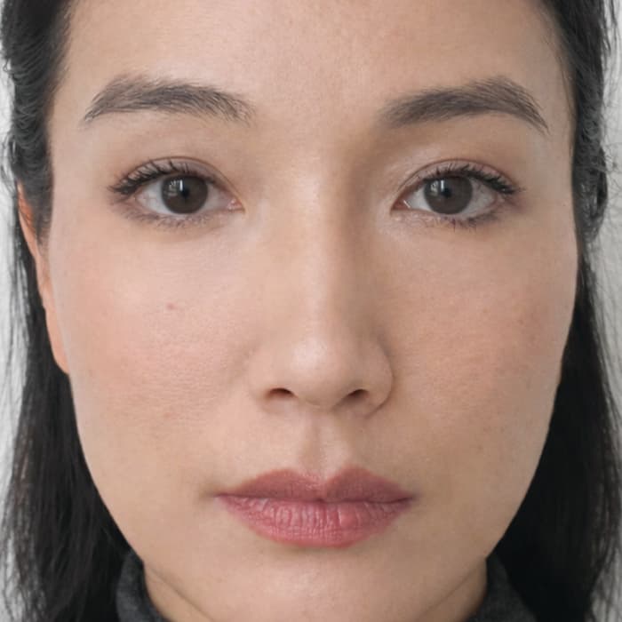 after-sofwave-treatment-harleystreet